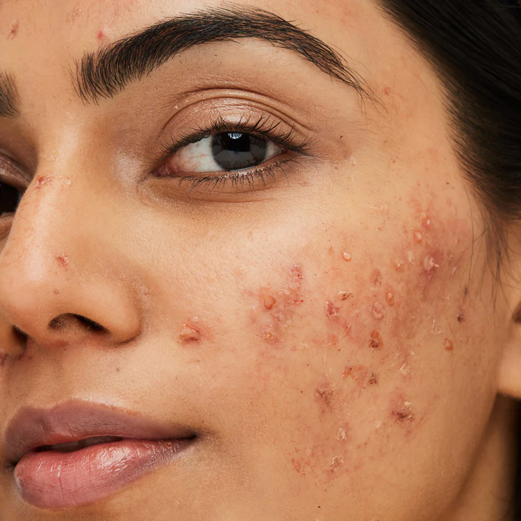 Acne Control