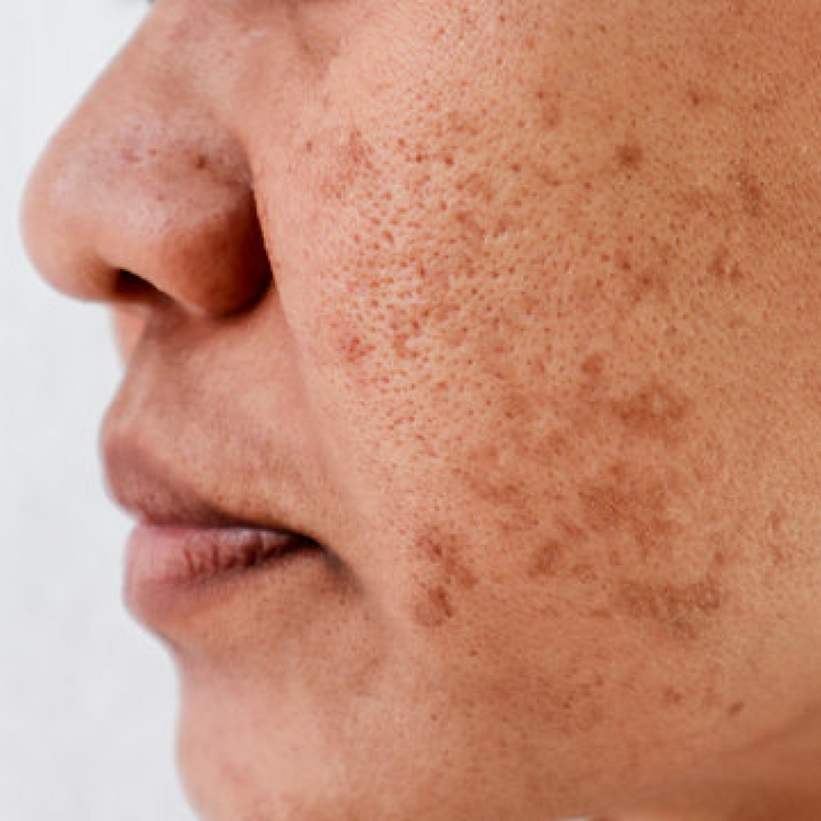Pigmentation